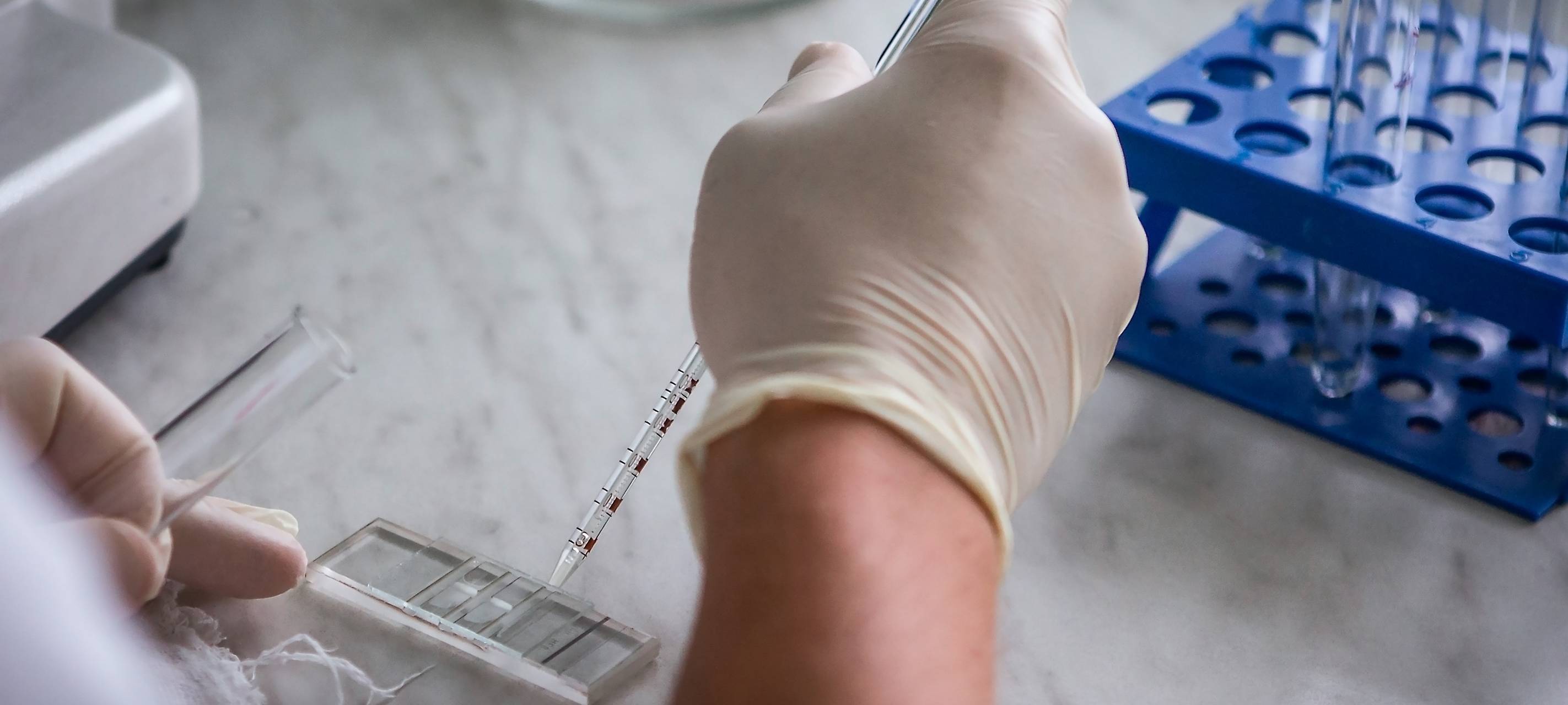 Laboruntersuchungen auf das Vorhandensein von Coronavirus COVID-19. Bluttest im Krankenhaus. Medizinische Ausrüstung.